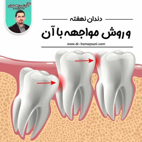 دندان نهفته و روش مواجهه با آن