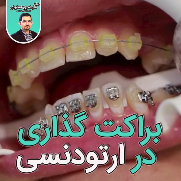 براکت گذاری در ارتودنسی