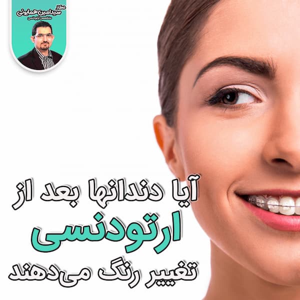 رنگ هنگام اروتودنسی