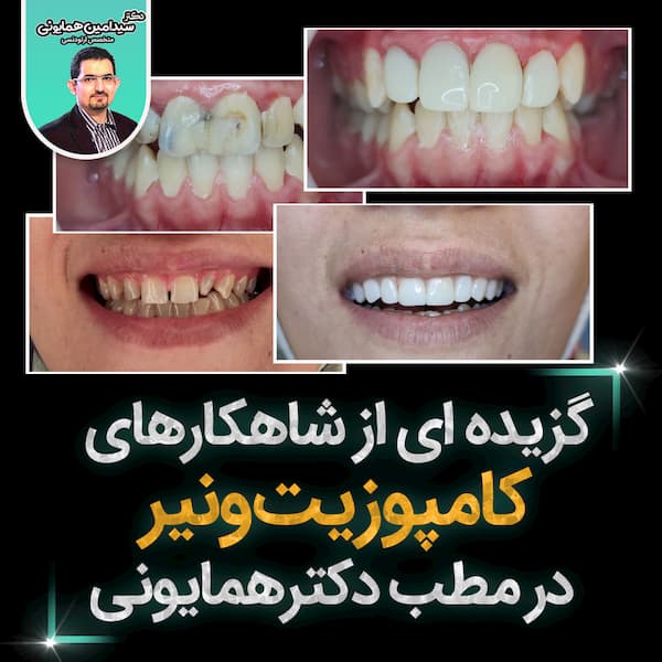 ای از شاهکارهای کامپوزیت ونیر در مطب دکترهمایونی