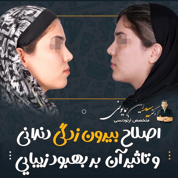 بیرون زدگی دندانی و تاثیر آن بر بهبود زیبایی