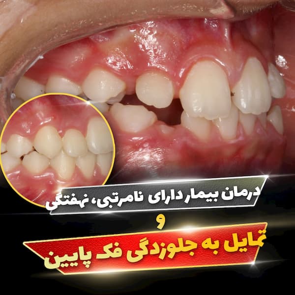 بیمار دارای نامرتبی، نهفتگی و تمایل به جلوزدگی فک پایین