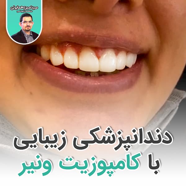 دندان پزشکی زیبایی با کامپوزیت ونییر