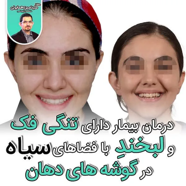 گوشه سیاه