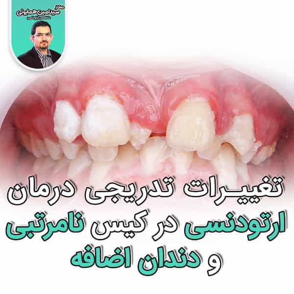 تغیرات تدریجی درمان ارتودنسی در کیس نامرتبی و دندان اضافه