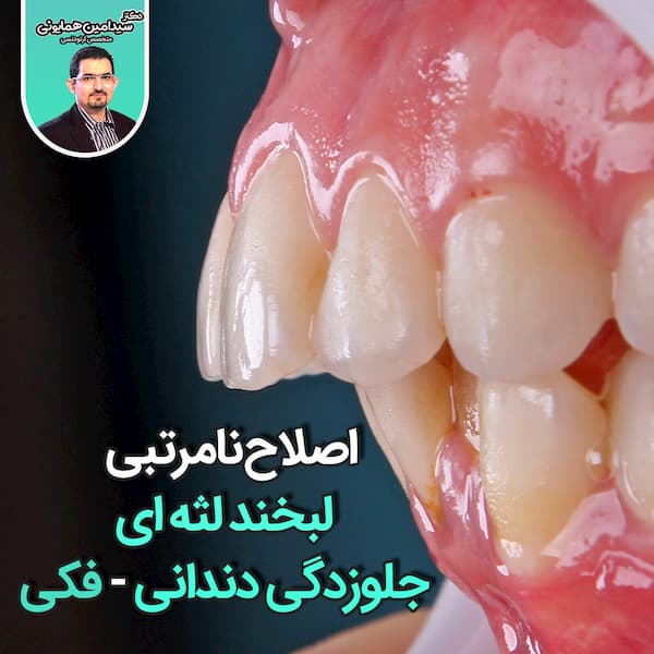 اصلاح لخند لثه ای جلوزدگی فکی دندانی