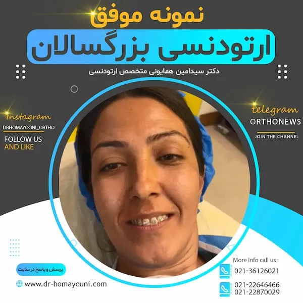 نمونه موفق ارتودنسی بزرگسالان