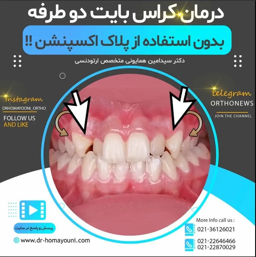 درمان کراس بایت دو طرفه بدون استفاده از پلاک اکسپنشن !!