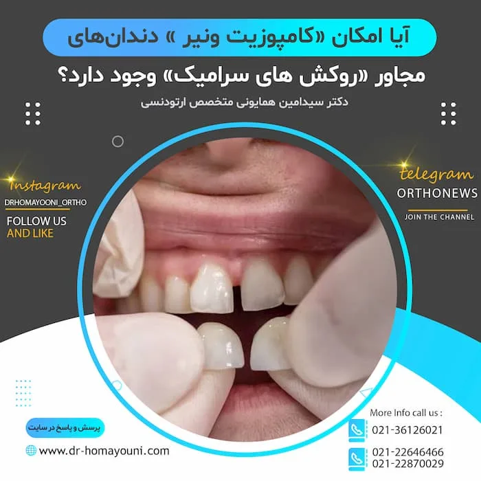 کامپوزیت ونیز