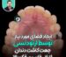 ایجاد فضای مورد نیاز توسط ارتودنسی جهت کاشت دندان لترال غایب در فک بالا