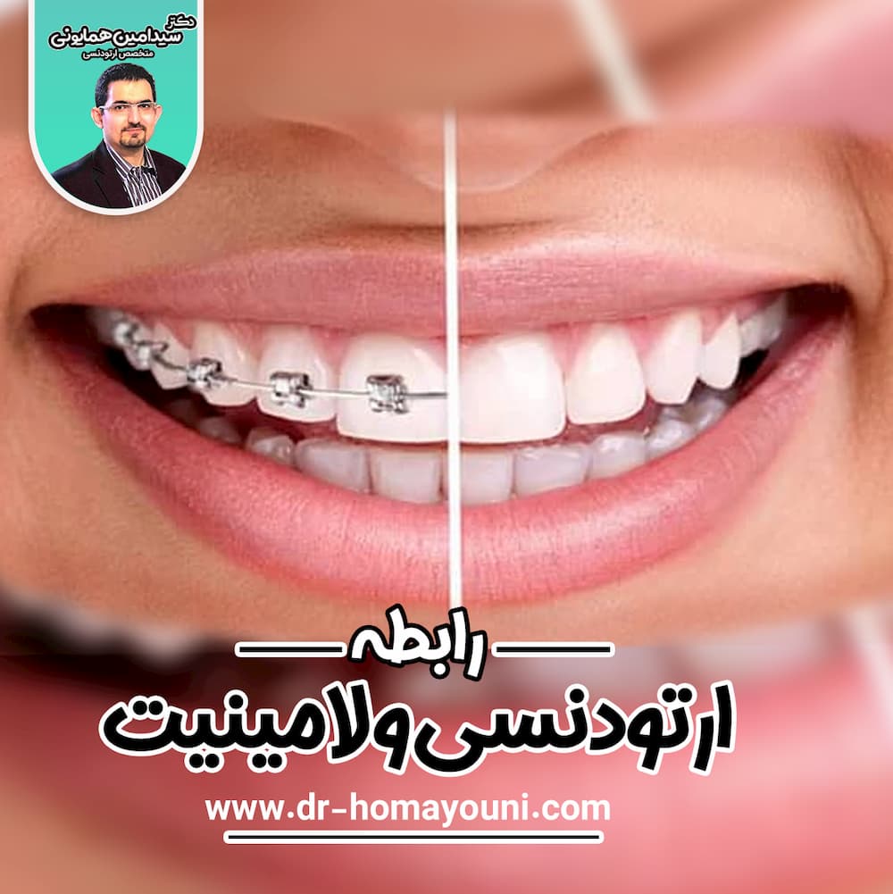 ارتودنسی و لامنتیت