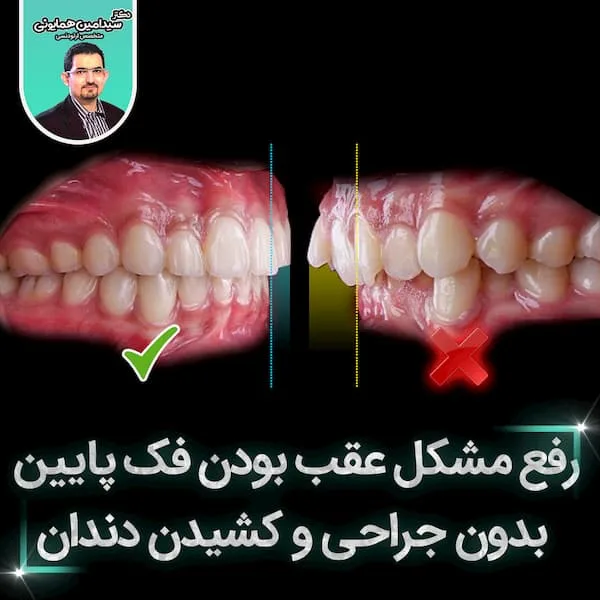 رفع مشکل عقب بودن فک پایین بدون جراحی و کشیدن دندان