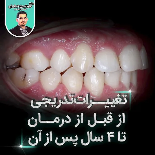 تغییرات تدریجی از قبل از درمان تا ۴ سال پس از آن